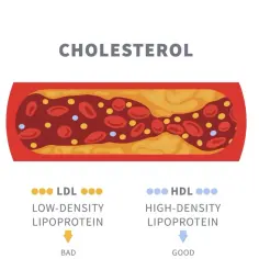 Przekrój naczynia krwionośnego z cholesterolem. Po lewej LDL (lipoproteiny o niskiej gęstości) - "złe", po prawej HDL (lipoproteiny o wysokiej gęstości) - "dobre".